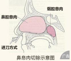 鼻息肉不及时治疗的危害有哪些