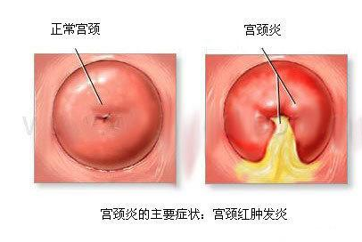 宫颈炎是怎么引起的